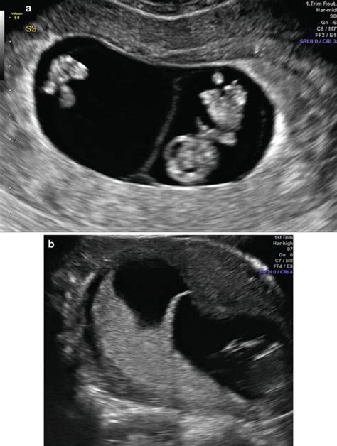 first trimester dating radiology